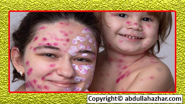 Chickenpox: Causes, Symptoms, Treatment, and Prevention Full in Detail